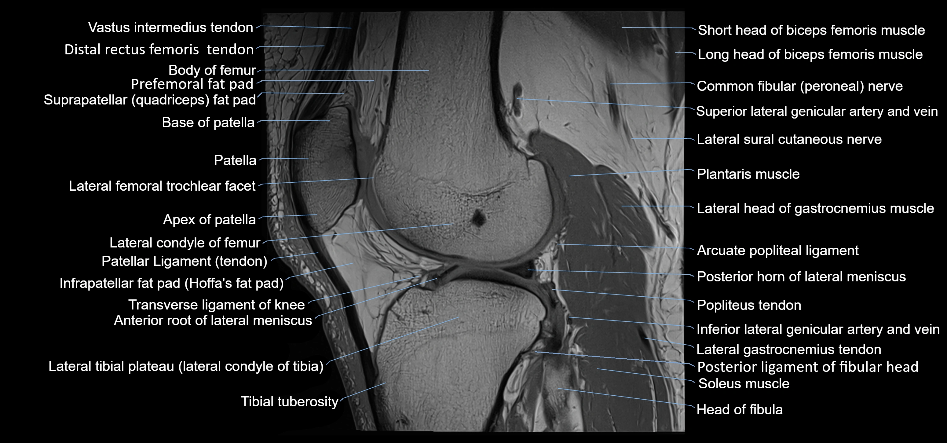 MRI knee sagittal cross sectional anatomy labelled 3T radiology image-00031.webp